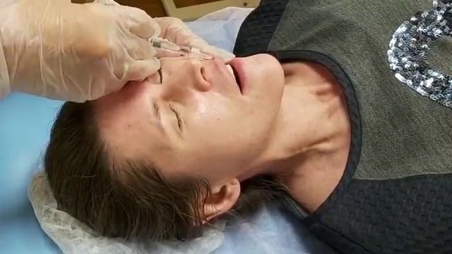 АирисКом студенты учатся: коррекция губ при сильной ассиметрии, филлер Princess. смотреть онлайн