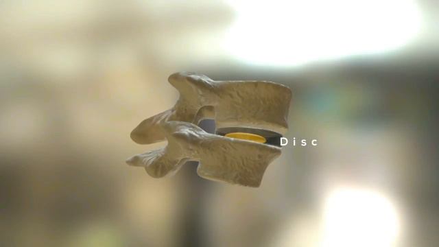 Slipped Disc in Lower Back [Part 3/6] स्लिप डिस्क क्या होता है ?