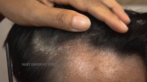 Combing Dandruff Big Flakes On Front Side Satisfying #813