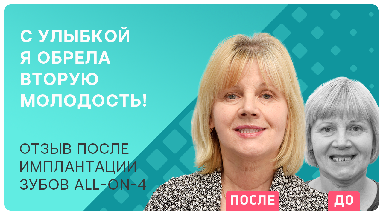 Новая улыбка и вторая молодость после имплантации all-on-4 – отзыв пациентки