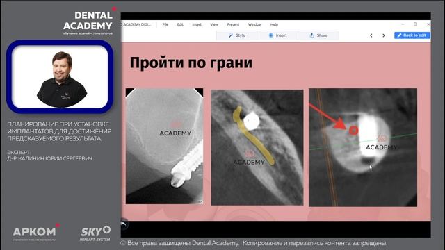 Планирование при установке имплантатов для достижения предсказуемого результата смотреть онлайн