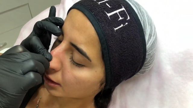 İple burun asma ,коррекция носа нитями,нитевая подтяжка,