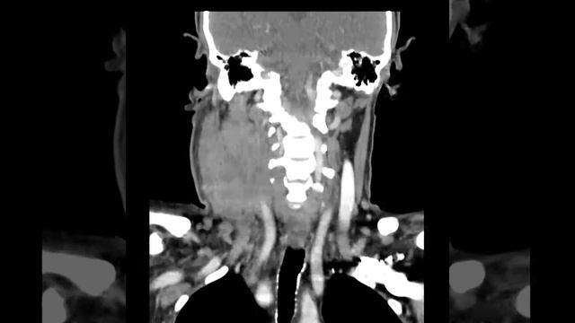 Опухоль шеи