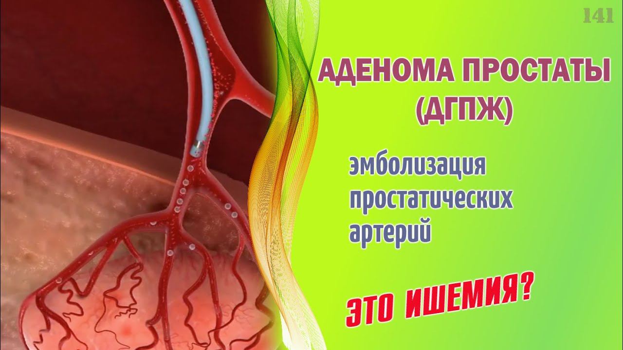 Аденома простаты. Лечение эмболизацией артерий. Это ишемия?