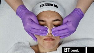 Процедура Гликолевый пилинг 30%  BTpeel