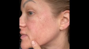 Moxi & BBL laser facial treatment
