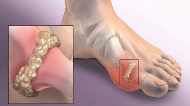 Почему болят большие пальцы на ногах? смотреть онлайн
