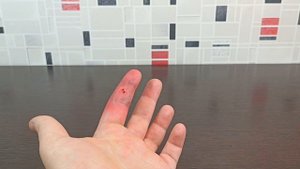 КАК ИЗБАВИТЬСЯ ОТ УКУСА ОГРОМНОГО МУРАВЬЯ ЛИСТОРЕЗА. Последствия укуса