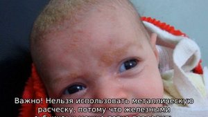 Корочки на голове у грудничка — как убрать