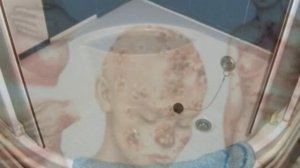 Zamburug’li kasalliklar / Замбуругли касалликлар / Грибок