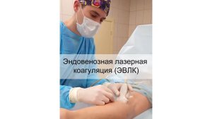 Операция от варикоза лазером - ЭВЛК