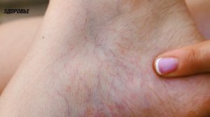 Варикоз ужасно боится этих домашних мазей! + рецепт