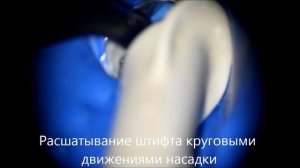 Извлечение анкерного штифта из зуба. Screw post removing.