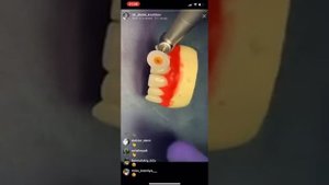 Полировка зубов дисками Kagayaki