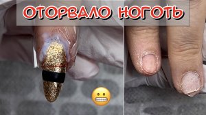 Травма ногтя. Что делать?