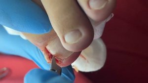 Вросший ноготь | осколки | воспаление | подросток