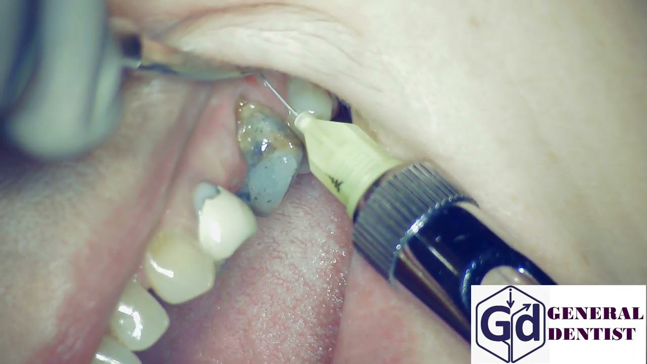 Infiltration anesthesia for extraction 26 tooth, and implantation  area 25,26.