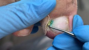 Вросший ноготь у подростка | установка системы | 3ТО | часть 2