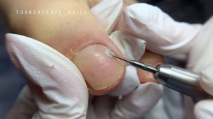 Гнойный онихолизис? Гигиенический педикюр с сюрпризом #подология #педикюр #подологическийпедикюр