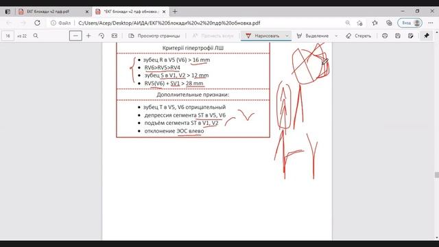 ЕКГ блокада ніжок, гіпертрофія частина 2 смотреть онлайн