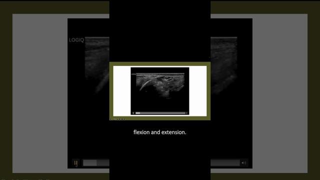 #ultrasound Guided Interventions: Cases (Ulnar Nerve Subluxation)