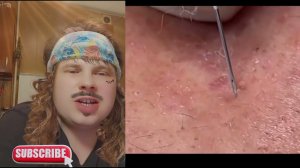 terminator / udalenie acne