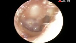 Эндоскопия уха: врожденная холестеатома
