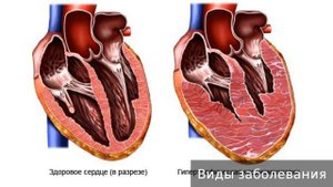 Кардиомегалия  Как лечить кардиомегалию
