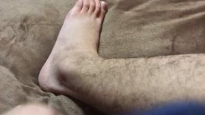 Перелом лодыжки со смещением. Часть 7