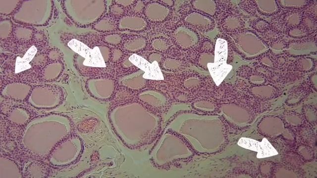 Разбор гистологического препарата: Щитовидная железа смотреть онлайн