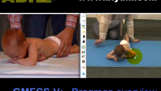 Motor Development Progress Overview Quadriplegic Cerebral Palsy Child GMFCS 5 смотреть онлайн