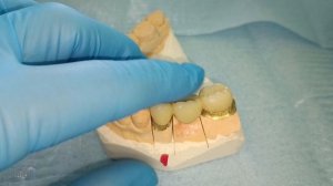 протезирование