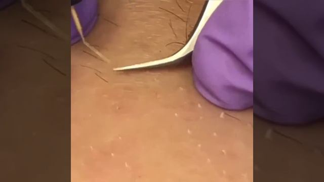 Электроэпиляция - удаление нежелательных волос навсегда в центре косметологии МИАС смотреть онлайн