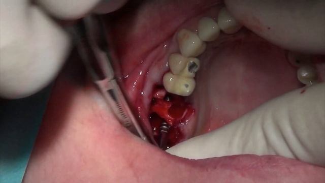 Dentium SuperLine III. Immediate placement in maxillary molars. By Dr. Bechara смотреть онлайн