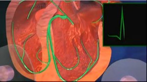 Брадикардия