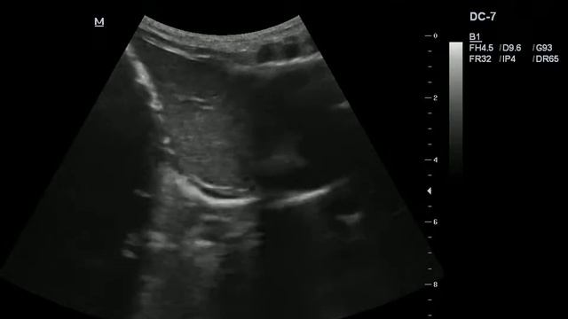 Пищевод, ГЭР смотреть онлайн