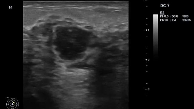 Патология молочной железы у кормящей мамы смотреть онлайн