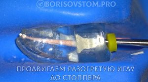 Вертикальная компакция методика непрерывной волны. Пломбировка жидкой гуттаперчей GuttaFill Guttaes