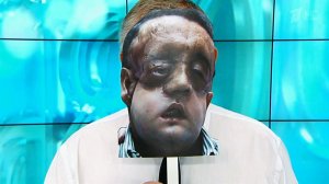 Достижения медицины. Операция по пересадке лица. Здоровье. Фрагмент выпуска от 23.10.2016