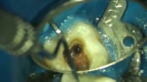 Удаление сломанного инструмента из канала зуба 37