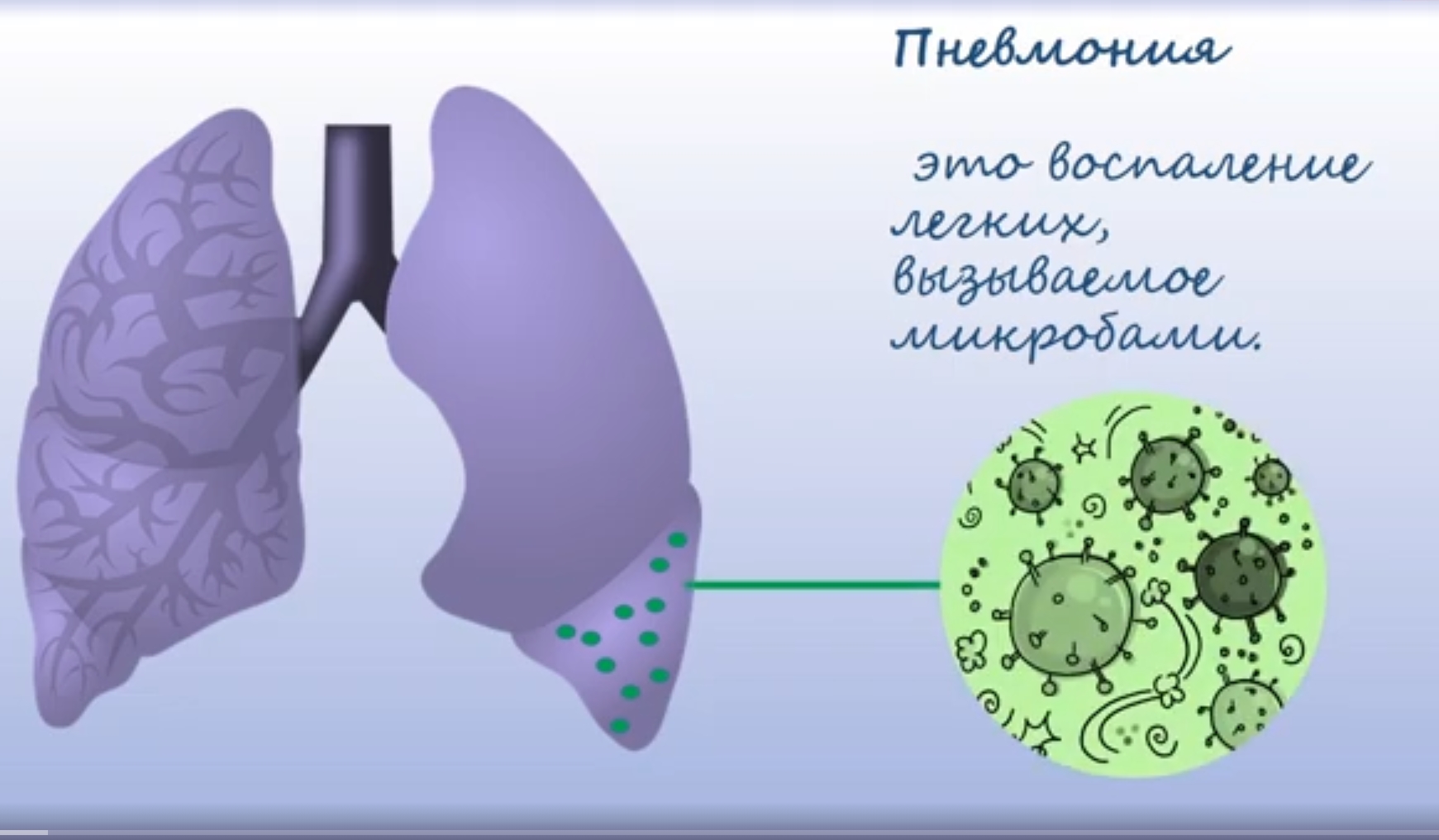Пневмония. Причины, Симптомы и признаки, диагностика, лечение. смотреть онлайн
