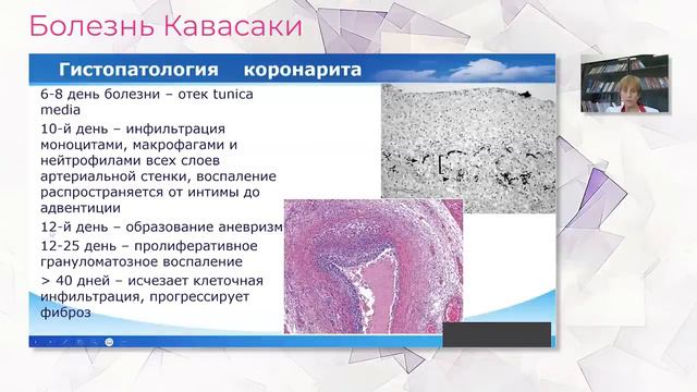 Болезнь Кавасаки у детей