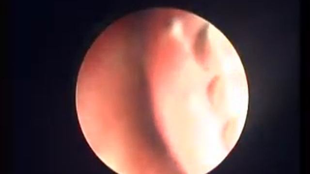 Видеоэндоскопический осомтр пациента с аденоидами 1 степени в больнице "Витацентр" смотреть онлайн