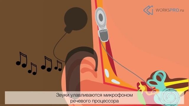 Кохлеарная имплантация