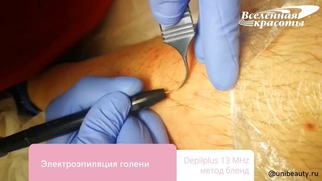 Электроэпиляция голени методом blend смотреть онлайн