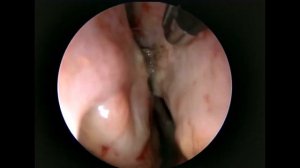 Rzayev R.R. Эндоскопическое иссечение синехий полости носа