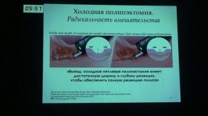 4 Агейкина Н.В. Холодная петлевая полипэктомия - неотъемлимая часть диагностической колоноскопии.