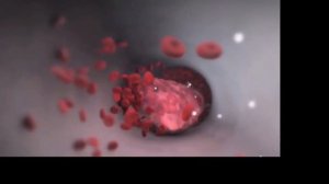 Образование тромбов.