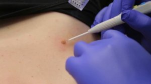 Удаление новообразований на аппарате Surgitron