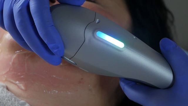 SMAS-лифтинг Ultraformen 3